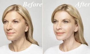 Before and after the use of Goji Cream