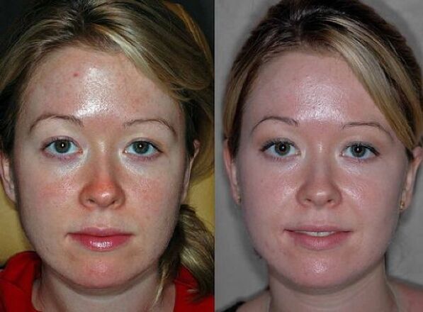photos before and after plasma rejuvenation procedure