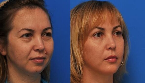 before and after skin rejuvenation by tightening photo 1
