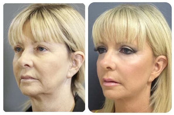 before and after skin rejuvenation by tightening photo 2