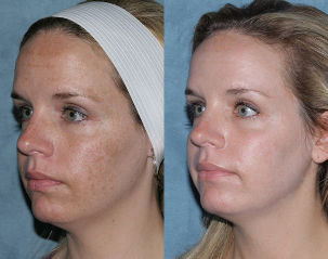 Before and after fractional skin rejuvenation of the face