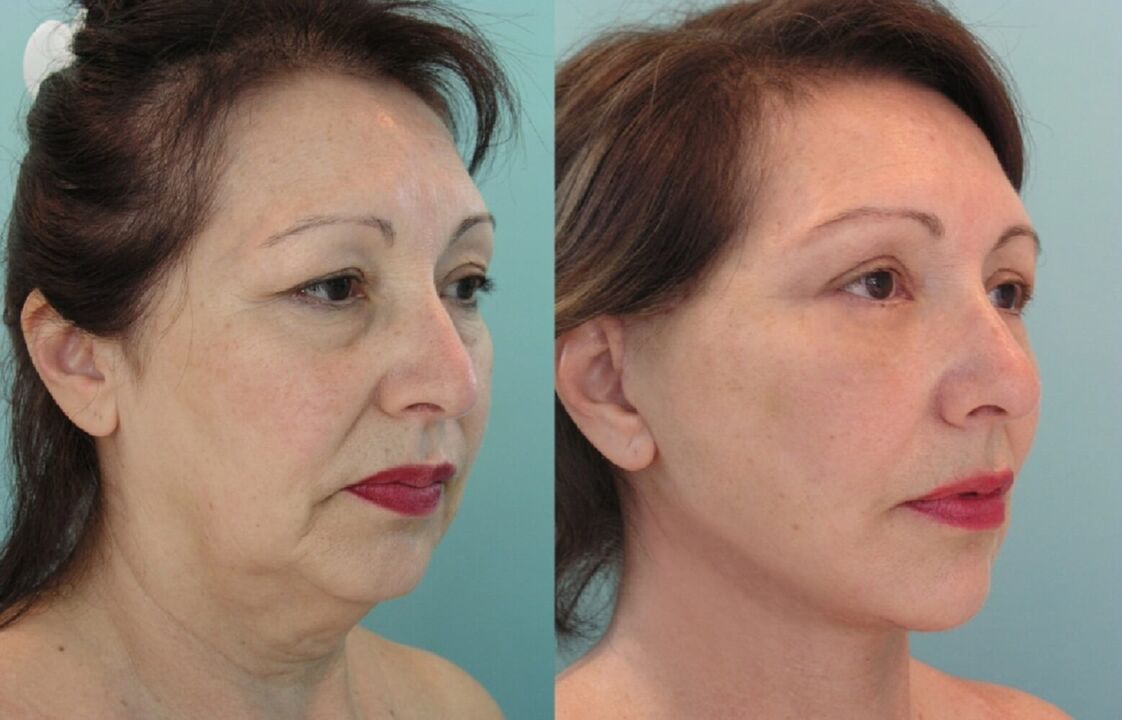 Before and after the thread facelift