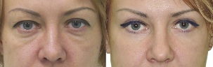 Photos before and after eyelid formation
