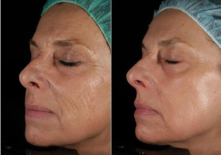 Laser resurfacing before and after