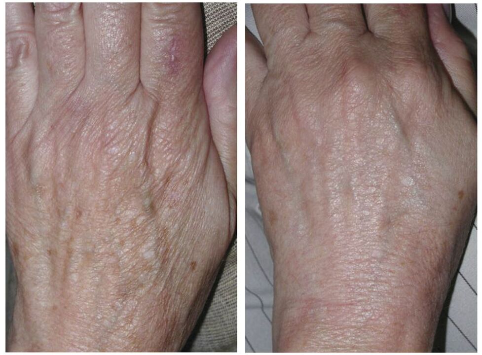 hand laser rejuvenation before and after photo
